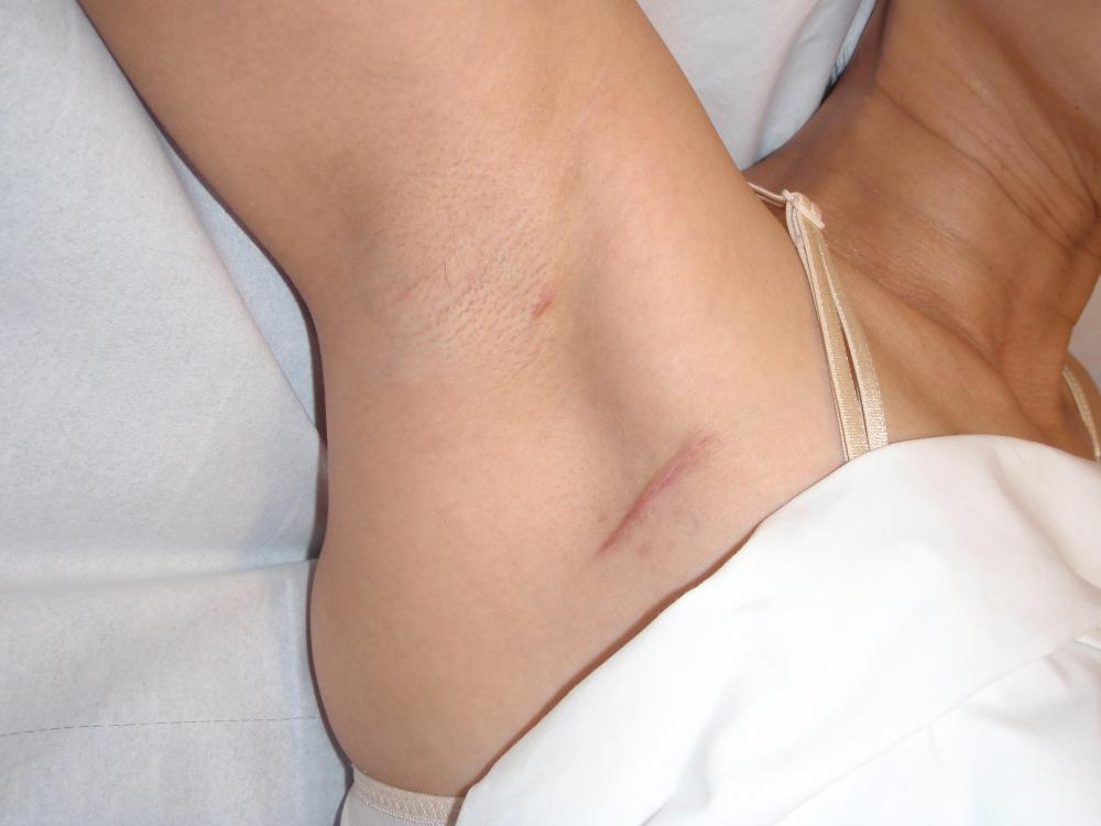 Armpit nodes herpes lymph Armpit lump: